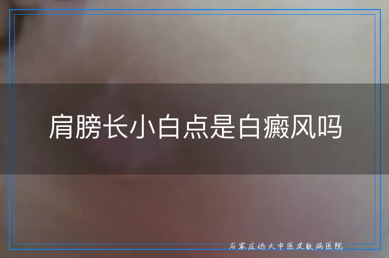 肩膀长小白点是白癜风吗