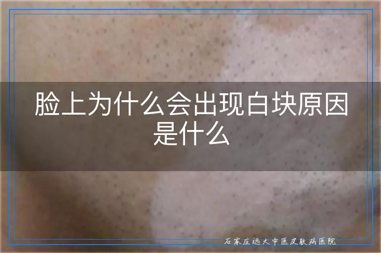 脸上为什么会出现白块原因是什么