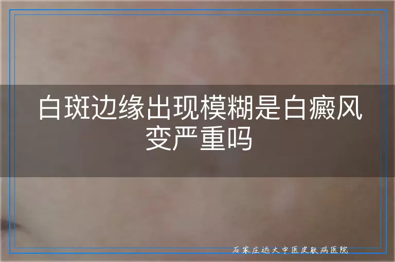 白斑边缘出现模糊是白癜风变严重吗