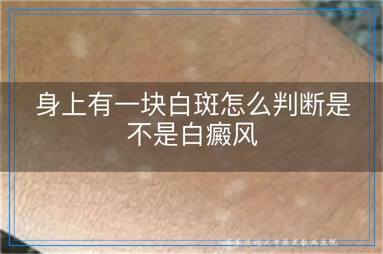 身上有一块白斑怎么判断是不是白癜风