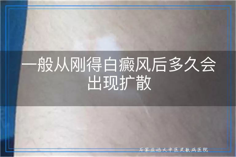 一般从刚得白癜风后多久会出现扩散
