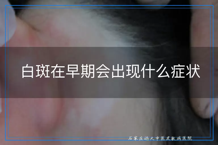 白斑在早期会出现什么症状