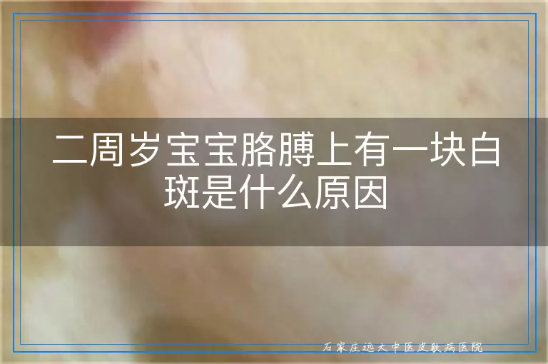 二周岁宝宝胳膊上有一块白斑是什么原因