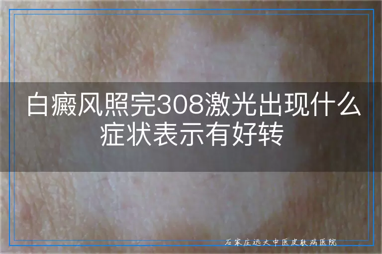 白癜风照完308激光出现什么症状表示有好转