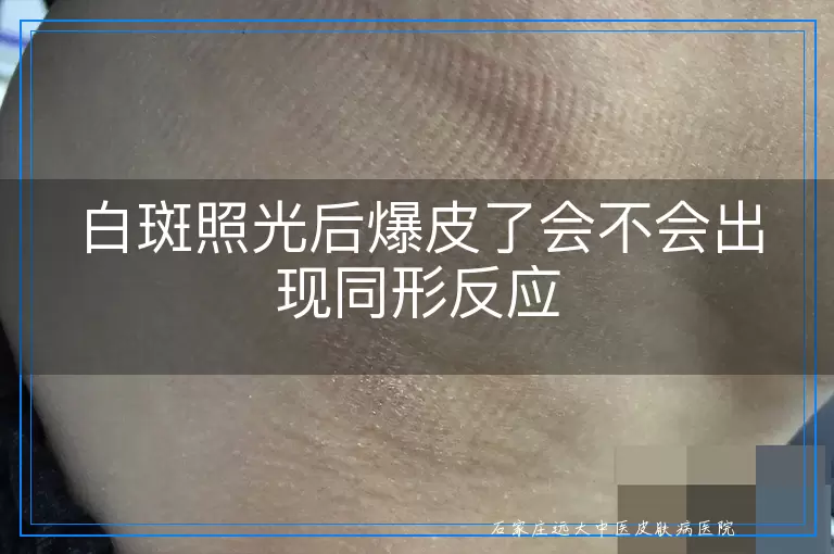 白斑照光后爆皮了会不会出现同形反应