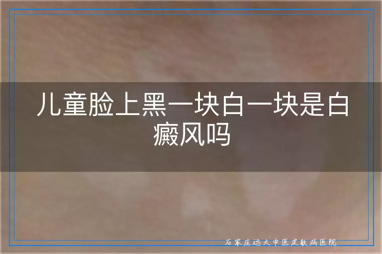 儿童脸上黑一块白一块是白癜风吗
