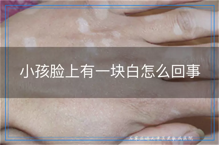 小孩脸上有一块白怎么回事
