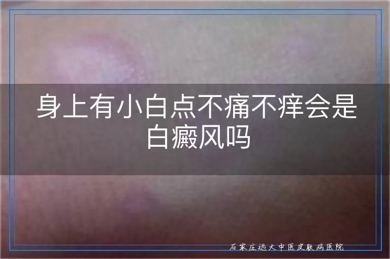 身上有小白点不痛不痒会是白癜风吗