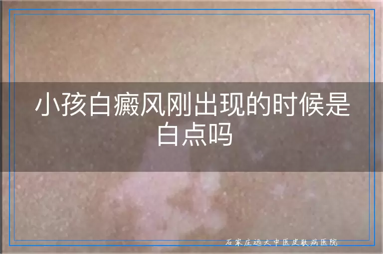 小孩白癜风刚出现的时候是白点吗