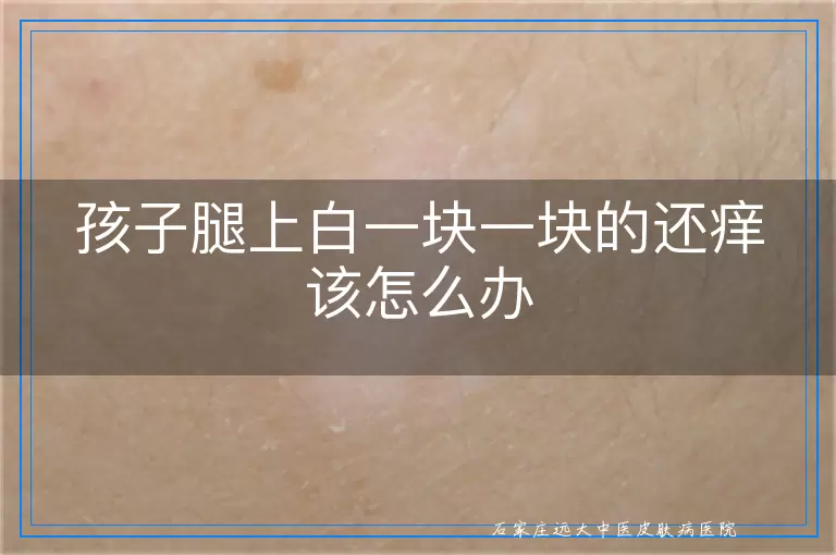 孩子腿上白一块一块的还痒该怎么办