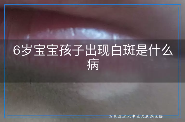 6岁宝宝孩子出现白斑是什么病