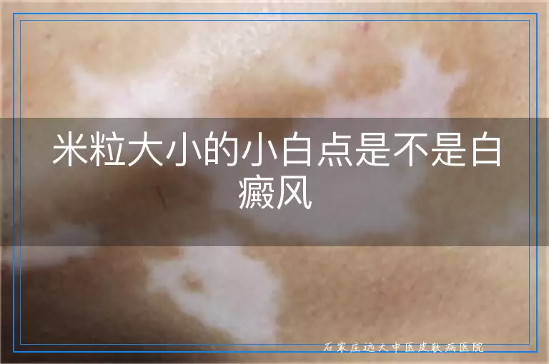 米粒大小的小白点是不是白癜风