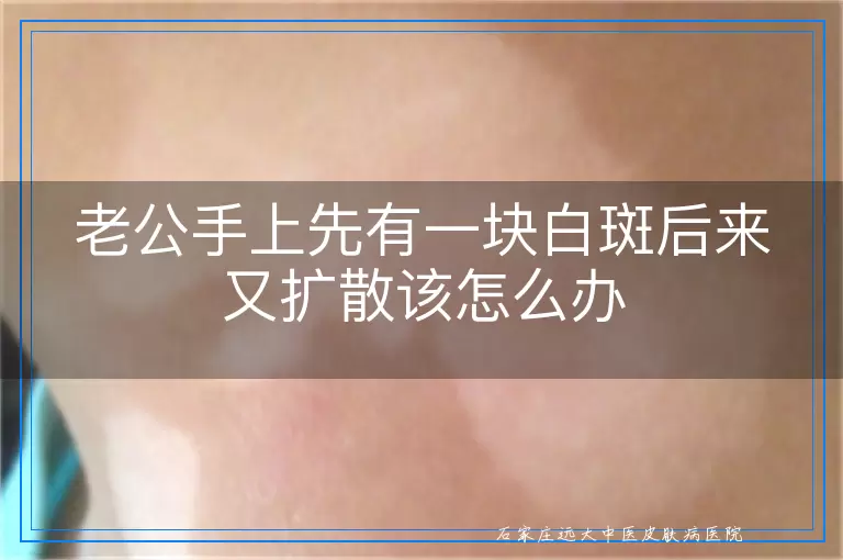 老公手上先有一块白斑后来又扩散该怎么办
