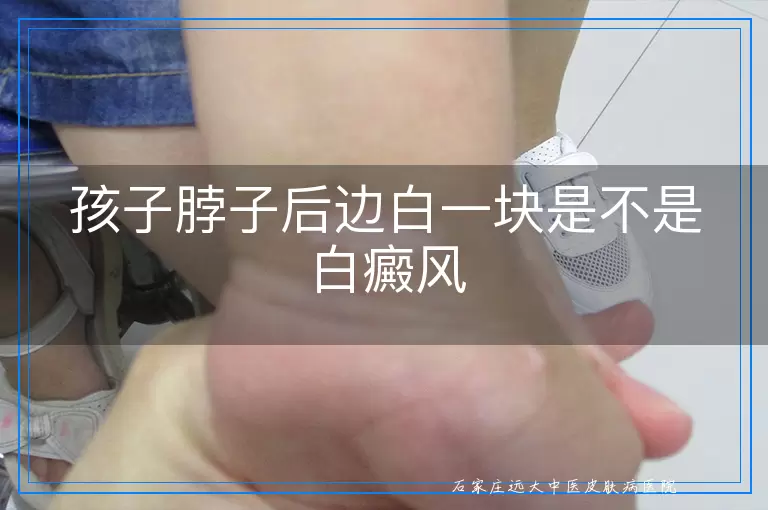 孩子脖子后边白一块是不是白癜风