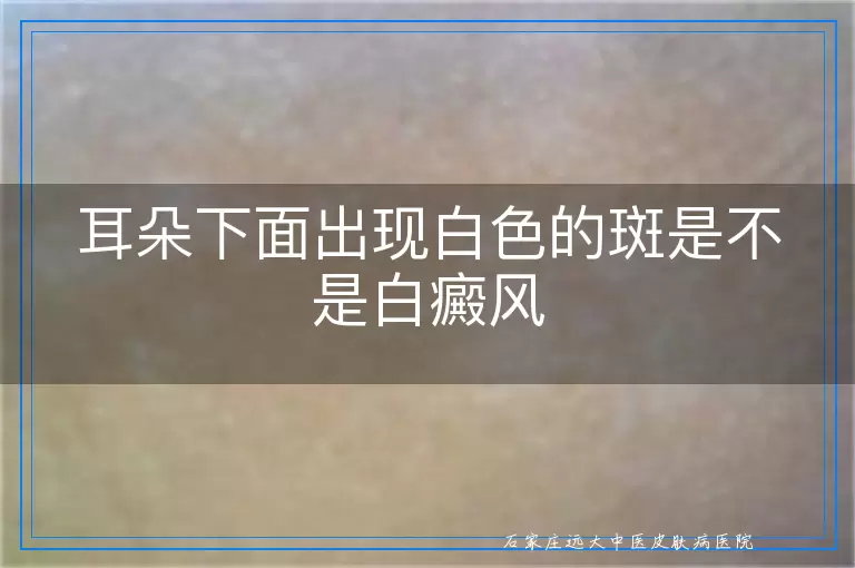 耳朵下面出现白色的斑是不是白癜风