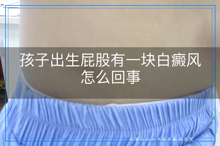 孩子出生屁股有一块白癜风怎么回事