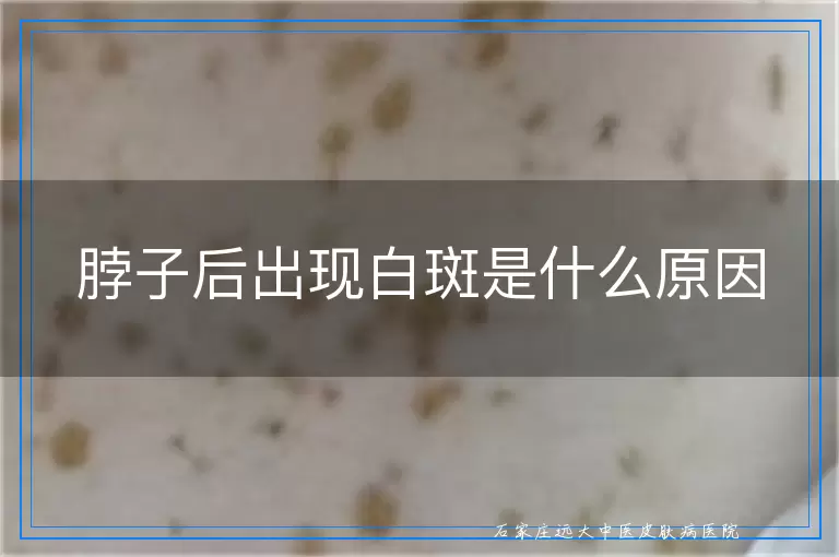 脖子后出现白斑是什么原因