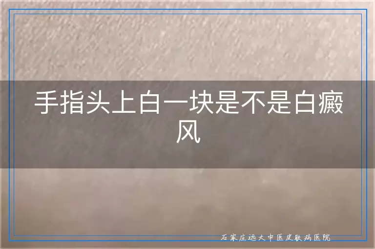 手指头上白一块是不是白癜风