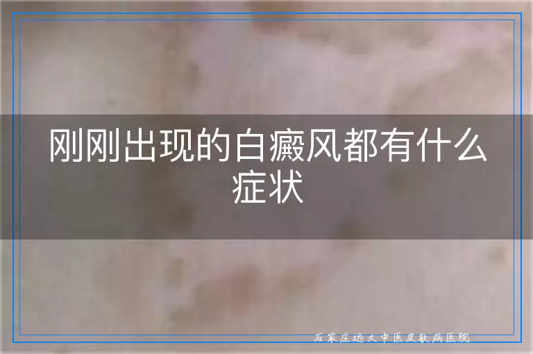 刚刚出现的白癜风都有什么症状