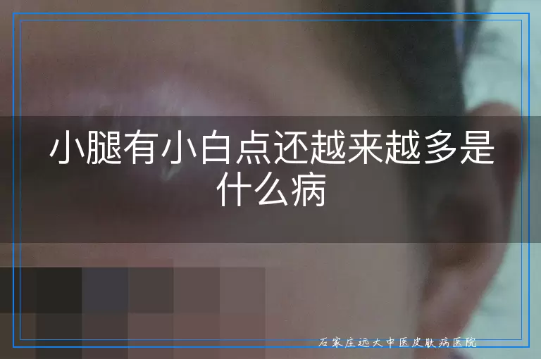 小腿有小白点还越来越多是什么病