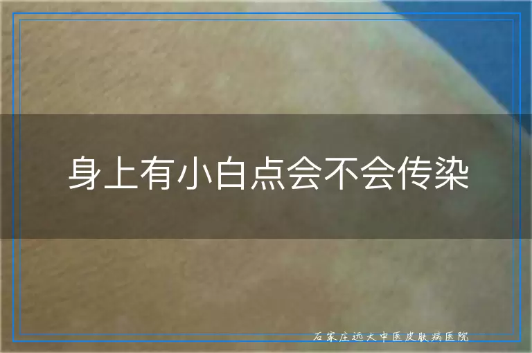 身上有小白点会不会传染