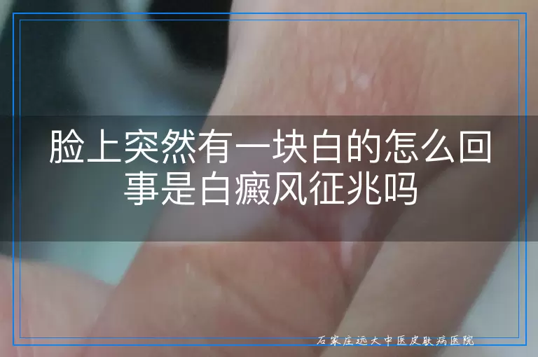 脸上突然有一块白的怎么回事是白癜风征兆吗