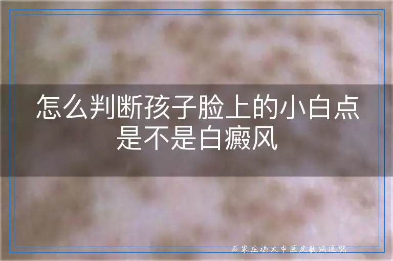 怎么判断孩子脸上的小白点是不是白癜风