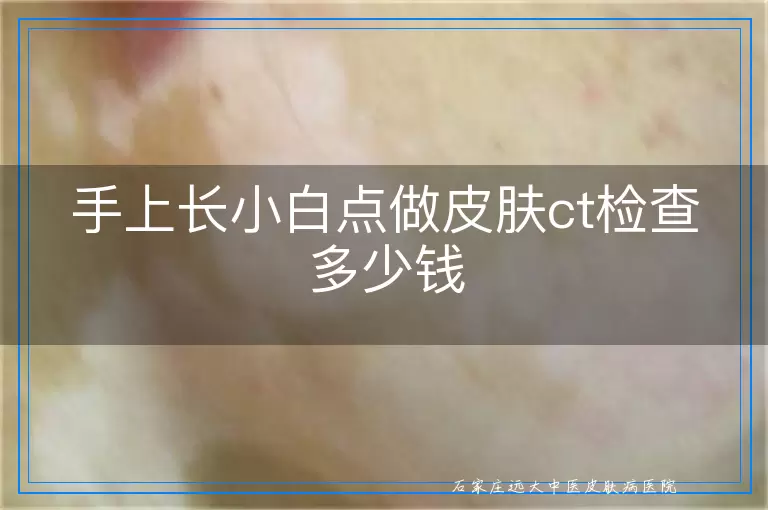 手上长小白点做皮肤ct检查多少钱