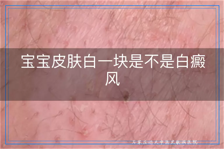 宝宝皮肤白一块是不是白癜风