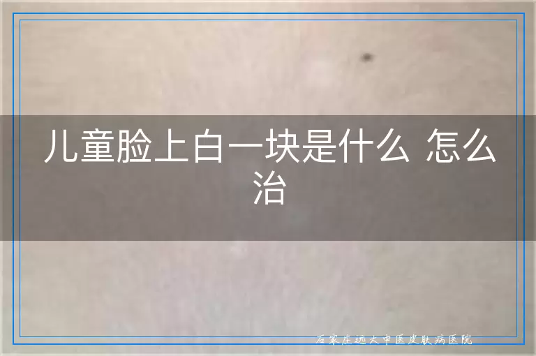 儿童脸上白一块是什么 怎么治