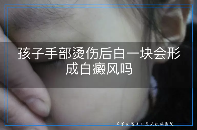 孩子手部烫伤后白一块会形成白癜风吗