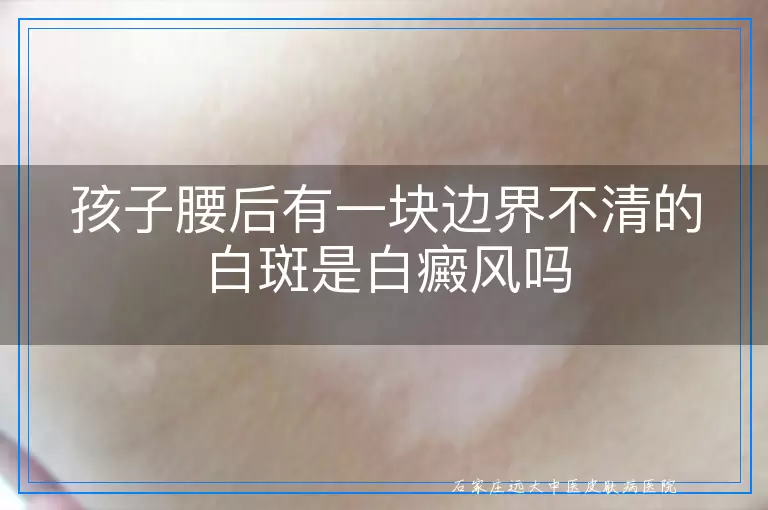 孩子腰后有一块边界不清的白斑是白癜风吗