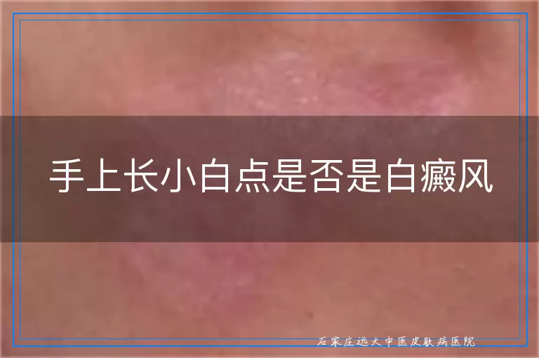 手上长小白点是否是白癜风
