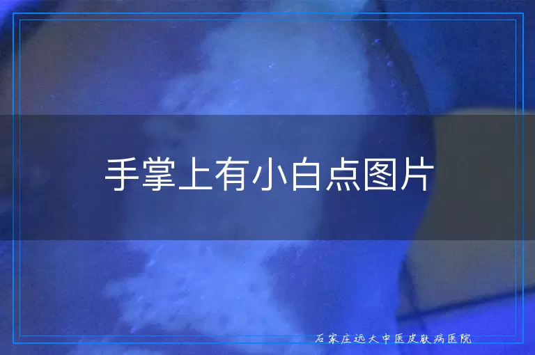 手掌上有小白点图片