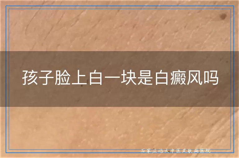 孩子脸上白一块是白癜风吗