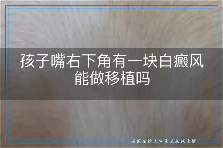 孩子嘴右下角有一块白癜风能做移植吗
