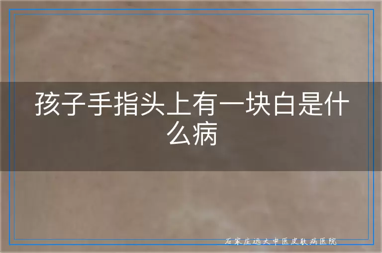 孩子手指头上有一块白是什么病