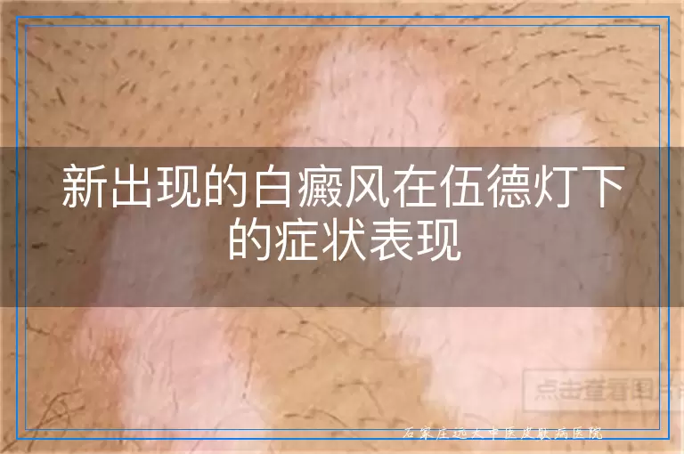 新出现的白癜风在伍德灯下的症状表现