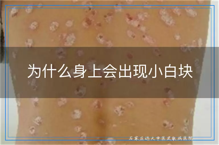 为什么身上会出现小白块