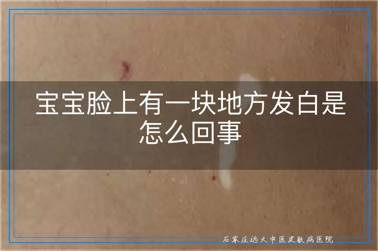 宝宝脸上有一块地方发白是怎么回事