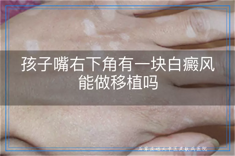 孩子嘴右下角有一块白癜风能做移植吗