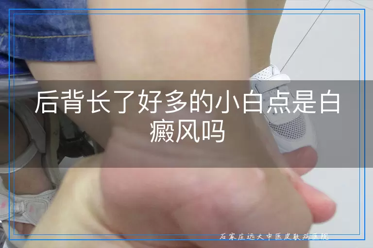 后背长了好多的小白点是白癜风吗
