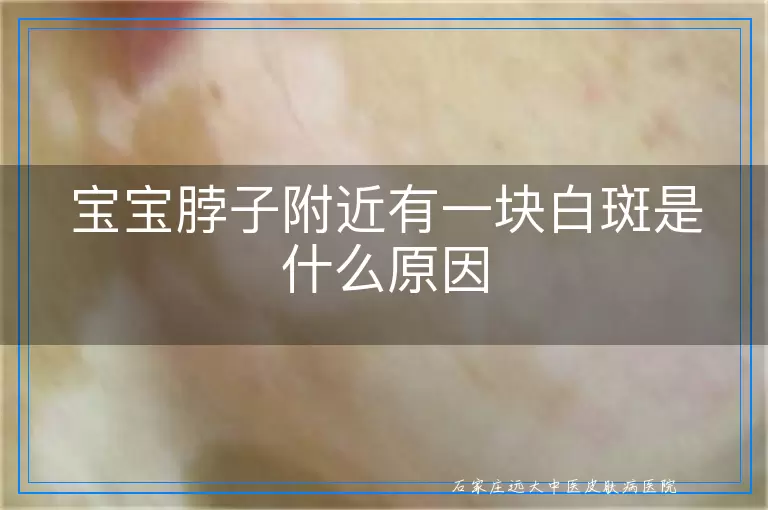 宝宝脖子附近有一块白斑是什么原因