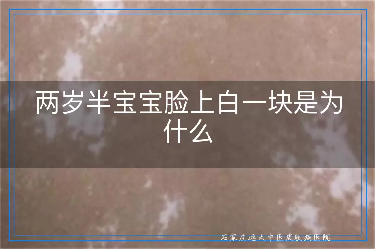 两岁半宝宝脸上白一块是为什么