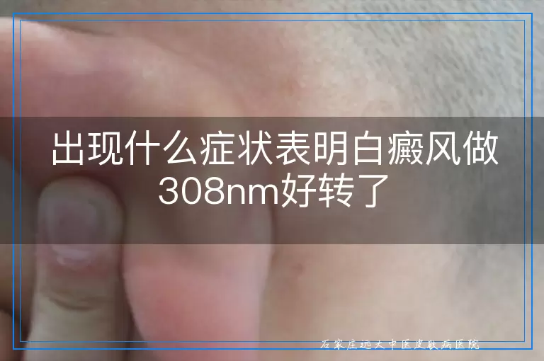 出现什么症状表明白癜风做308nm好转了
