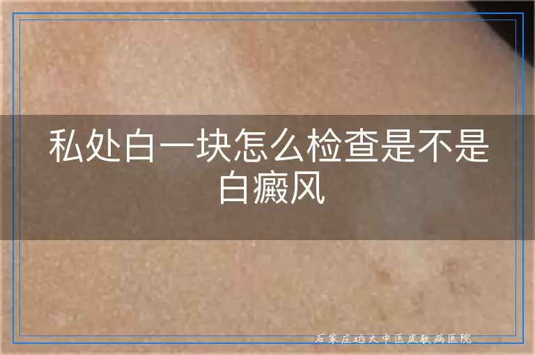 私处白一块怎么检查是不是白癜风