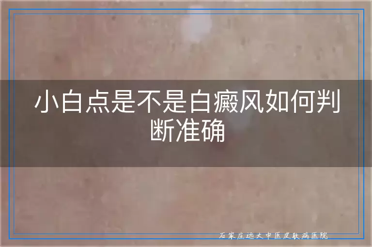 小白点是不是白癜风如何判断准确