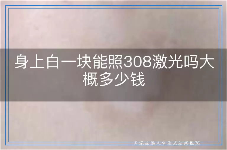 身上白一块能照308激光吗大概多少钱
