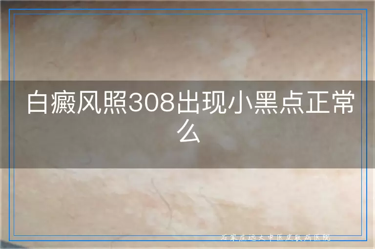 白癜风照308出现小黑点正常么