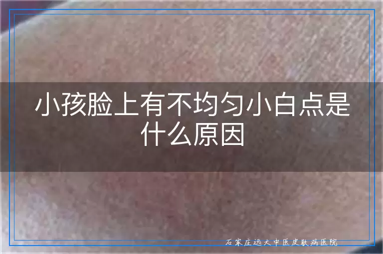 小孩脸上有不均匀小白点是什么原因